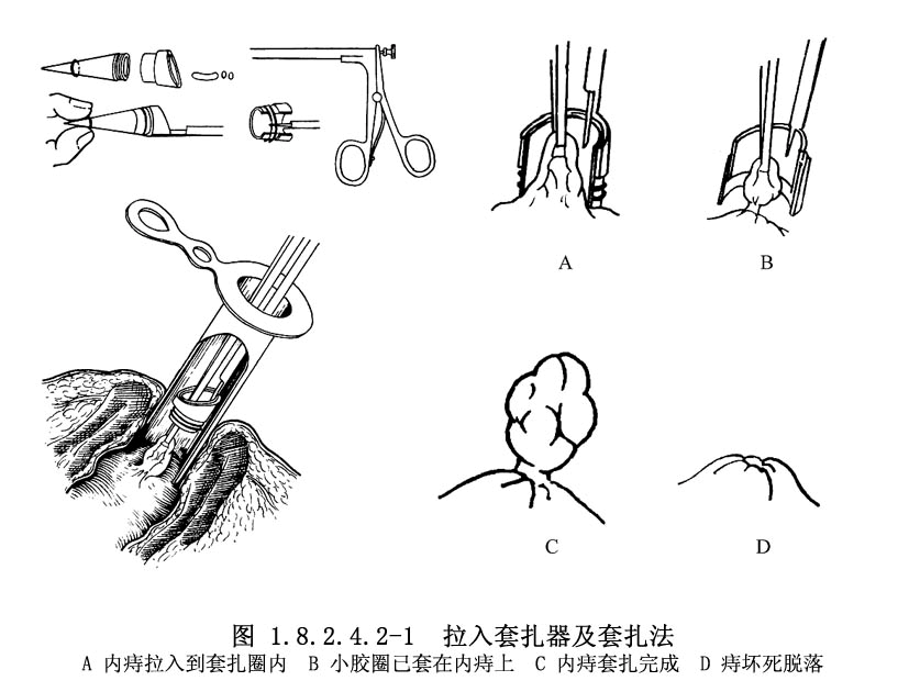 目前我们完全可以通过内镜从里面将肿大的痔核套扎,进入路径和操